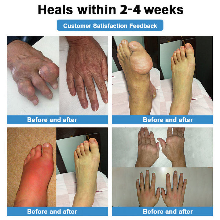 Official Store:👩⚕️Recommended by AAOS🏃♂️➡️AnnieCare® Nano-microneedle joint patch (Painless, long-lasting, suitable for arthritis, varicose veins and various orthopedic diseases)