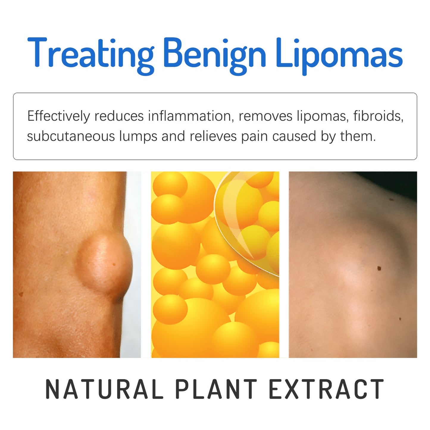 South Moon Lipoma Removal Cream Upgraded