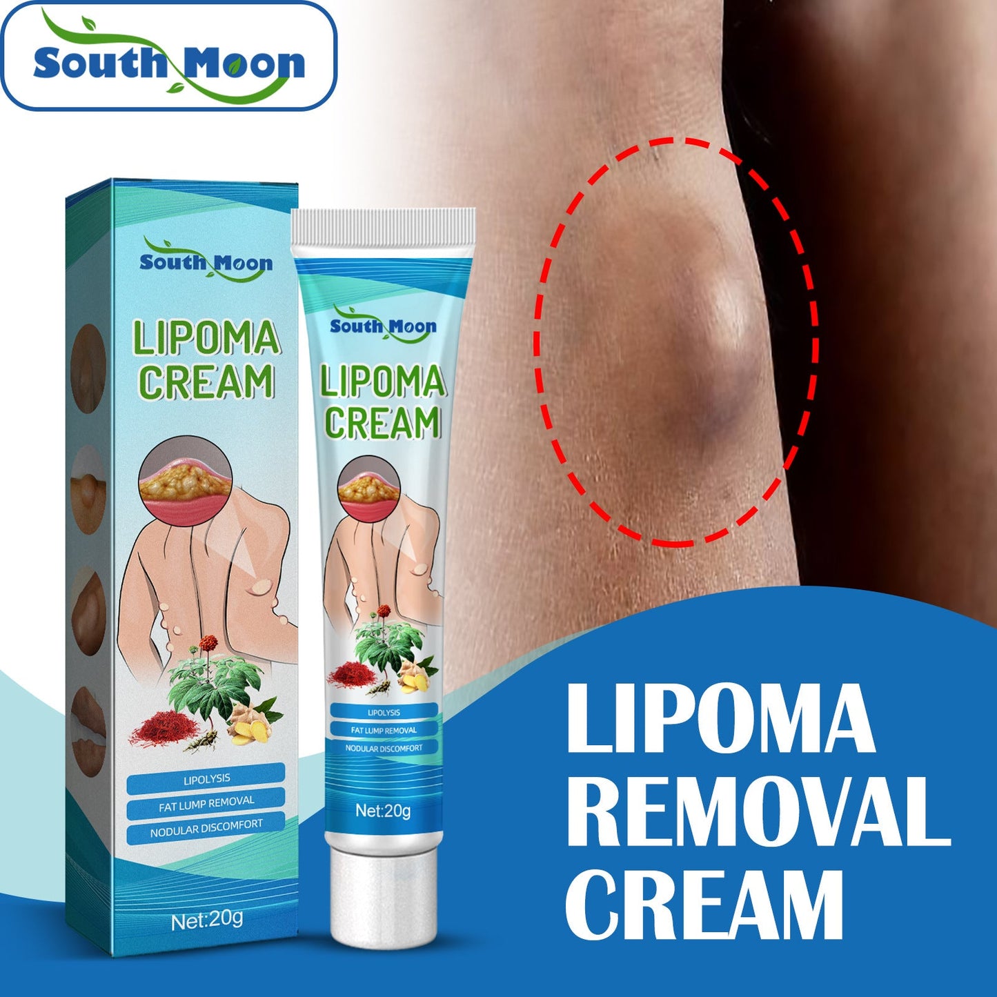 South Moon Lipoma Removal Cream Upgraded