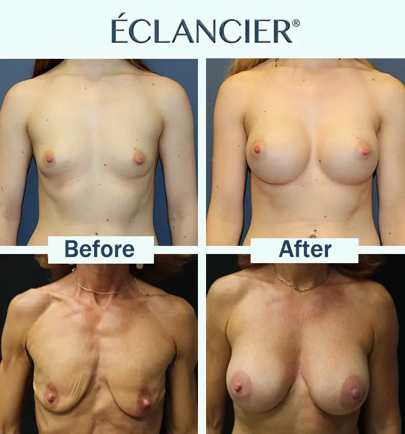 ÉCLANCIER® Targeted Breast Enhancement Advanced Nano Microneedle Patch