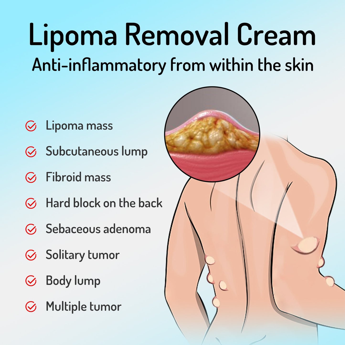 South Moon Lipoma Removal Cream Upgraded