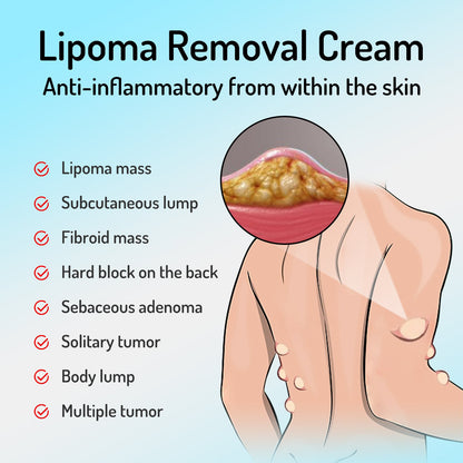 South Moon Lipoma Removal Cream Upgraded