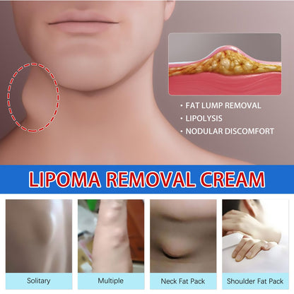 South Moon Lipoma Removal Cream Upgraded